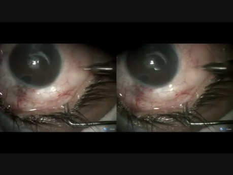 Failed Surgery, Inflammatory Glaucoma - Latest Step