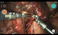 Right Middle Lobe Wedge Resection, Frozen Section (Adenocarcinoma), Middle Lobectomy and Lymphadenectomy with the Versius Surgical Robotic System