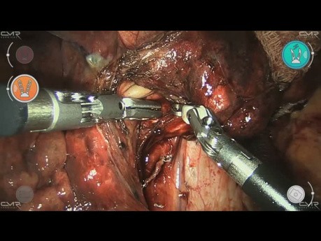 Right Middle Lobe Wedge Resection, Frozen Section (Adenocarcinoma), Middle Lobectomy and Lymphadenectomy with the Versius Surgical Robotic System