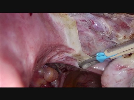 Hysterectomy (TLH) Using Simple Bipolar
