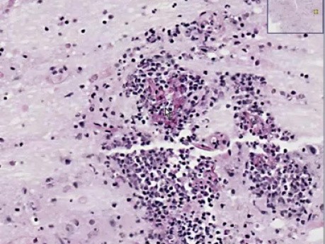 Mucormycosis meningoencephalitis