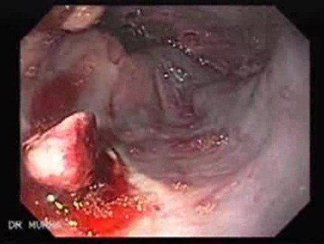 Severe Bleeding of the Upper Digestive System After Two Days of Band Ligation - Insertion of the Argon Plasma Coagulator