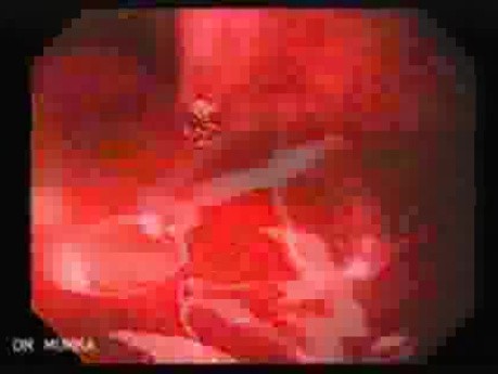 Severe Bleeding of the Upper Digestive System After Two Days of Band Ligation - Extensive Bleeding