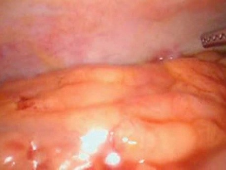 Colonic Perforation With Peritonitis - Laparoscopy (3 of 46)