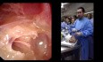 Endoscopic Ear Dissection - Part I