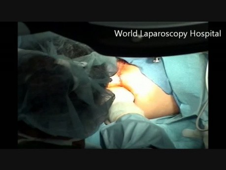 TEM - Transanal Endoscopic Microsurgery