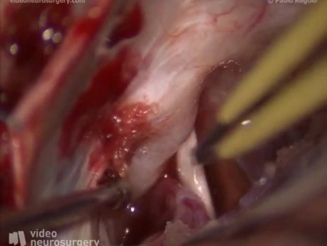 Hemifacial Spasm - Left Retrosigmoid Approach