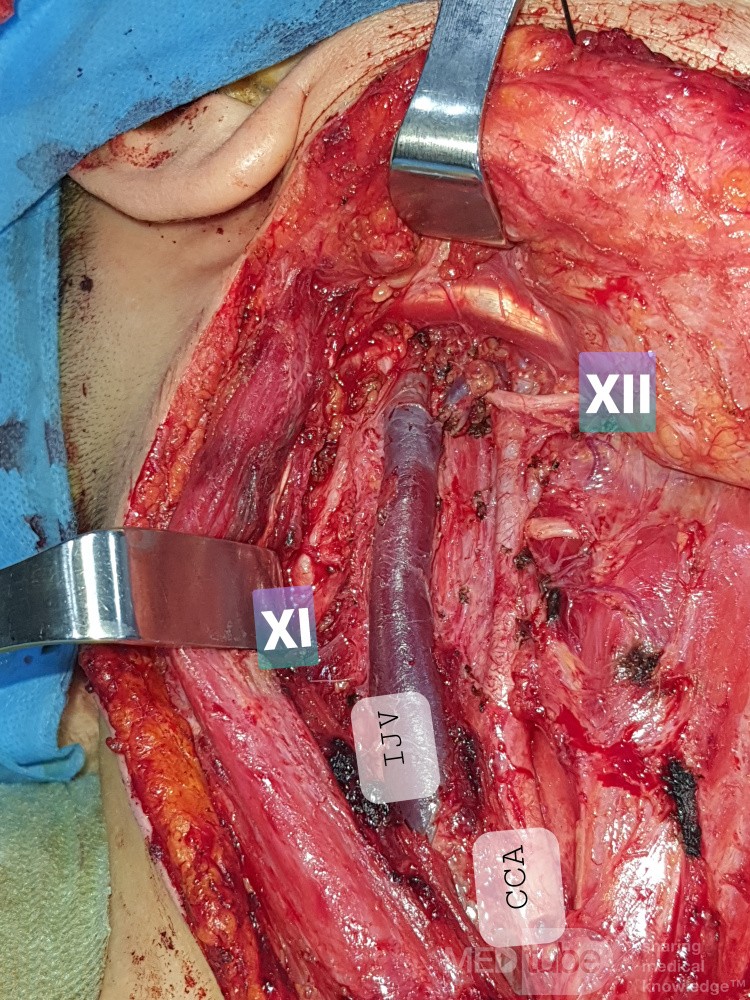 Selective Neck Dissection for Rt Thyroid Papillary Carcinoma