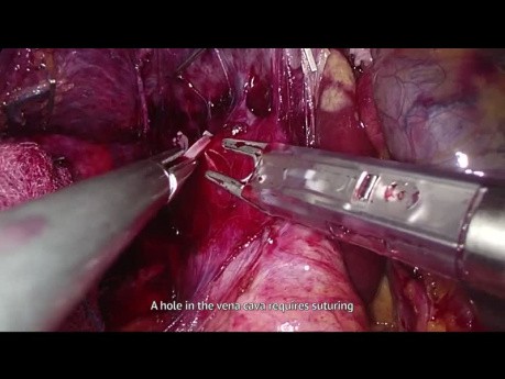 Laparoscopic Right Hemihepatectomy - Suturing Vena Cava, Bleeding from Liver Parenchyma