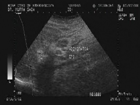 Ovarian Carcinoma with Gastric and Duodenal Metastases  - Ultrasonography of the Abdomen, Part 1