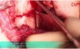Osteosynthesis of Low-neck Mandibular Condyle Fracture