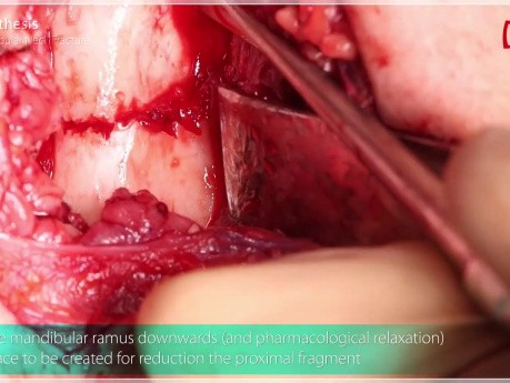 Osteosynthesis of Low-neck Mandibular Condyle Fracture
