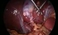 Laparoscopic suturing and knotting