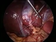 Laparoscopic suturing and knotting