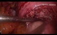 Myomectomy (Surgery for Fibroid Uterus)