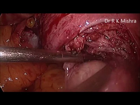 Myomectomy (Surgery for Fibroid Uterus)