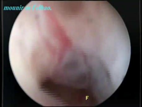 Vaginoscopy Performed in Outpatient Office