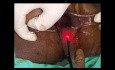 Ischiorectal Abcess with Fistula in Ano