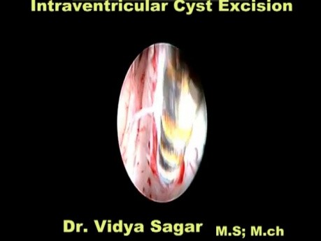 Endoscopic Intraventricular Cyst Excision