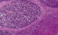 Hepatocellular carcinoma in cirrhosis - Histopathology - Liver