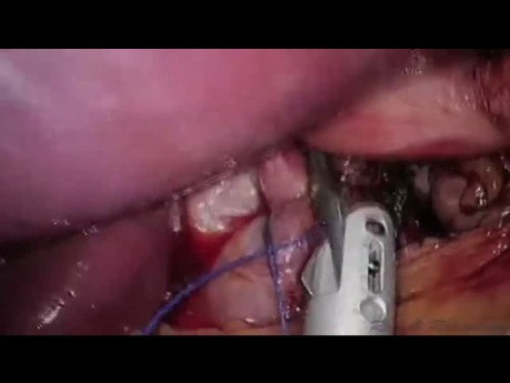 LESS Toupet with Concomitant Cholecystectomy