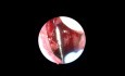 Shaver-assisted adenotomy whith zero-optic endoscope control