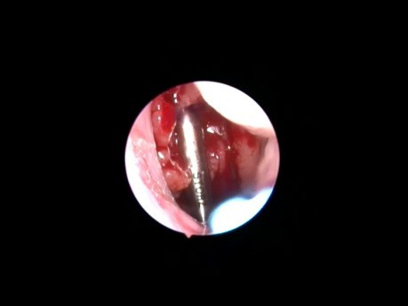 Shaver-Assisted Adenotomy with Zero-Optic Endoscope Control