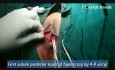 Hymenoplasty Virginity Restoration Surgery
