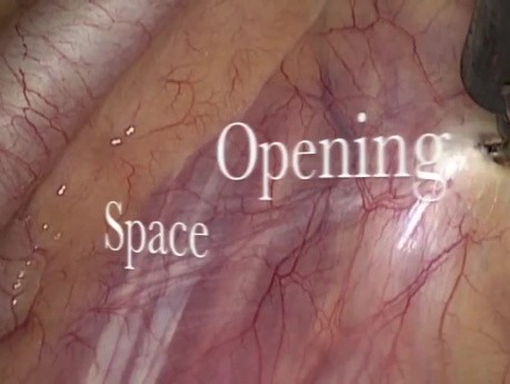 Endoscopic thoracic sympathectomy video