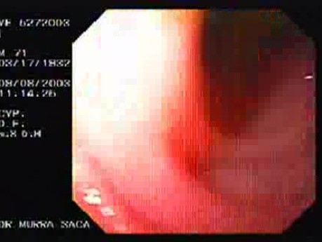 Esophago-Jejunostomy Roux-en-Y (2 of 6)