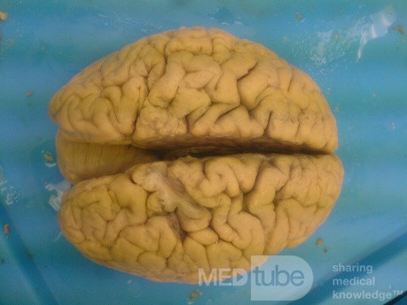 Cerebrum- Autopsy View