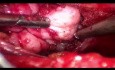 Endoscopic Excision of Giant Fibroadenoma