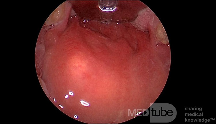 Peritonsillar Abscess (Quinsy)