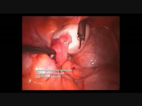 Ovarian Fenestration and Chromopertubation 