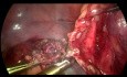 Removal of Large Ovarian Cyst
