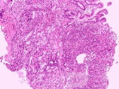 Ovarian Carcinoma Metastatic to Stomach and Duodenum (18 of 20)