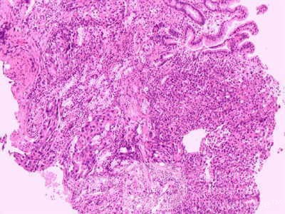 Ovarian Carcinoma Metastatic to Stomach and Duodenum (18 of 20)
