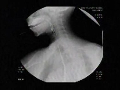 Esophageal Achalasia (4 of 10)