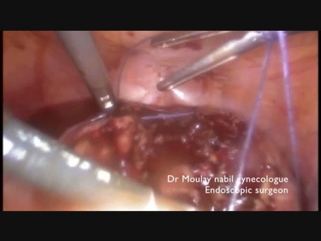 Standard Myomectomy for Big Myoma (more than 10 cm)