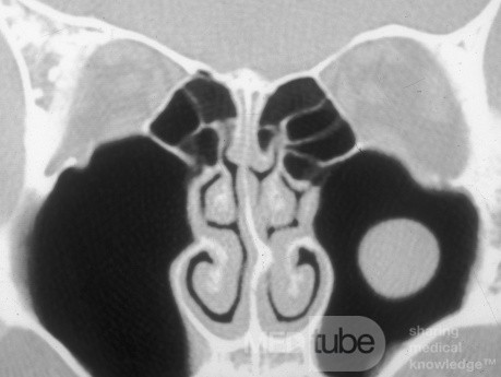Maxillary Sinus Cyst [CT scan]