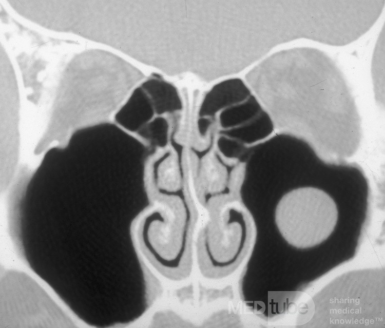 Maxillary Sinus Cyst [CT scan]
