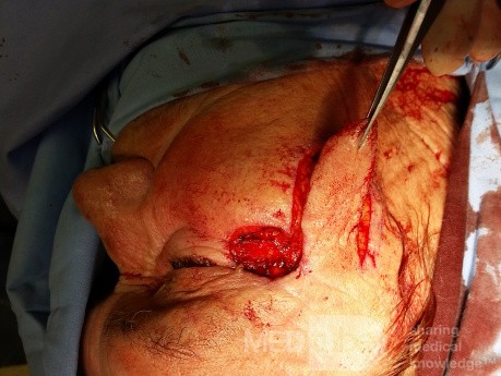 Basal Cell Carcinoma (2)