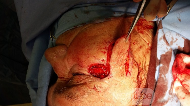 Basal Cell Carcinoma (2)