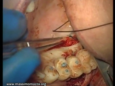 Reconstruction Of Adhesive Gingiva (3/5)