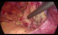 Laparoscopic Sigmoidectomy - Lateral to Medial Splenic Flexure Mobilization