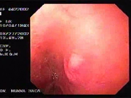 Duodenal Carcinoid (1 of 3)