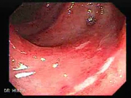 Diverticular Colitis (7 of 7)