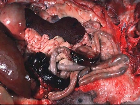 Hemodynamic Disorders, Thromboembolic Disease and Shock - MSP - 4d