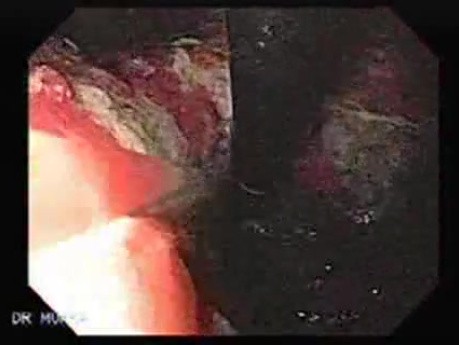 Synchronous Cancer Gastric and Esophageal (2 of 9 )