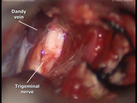 Acoustic Neuroma - Retrosigmoid Approach